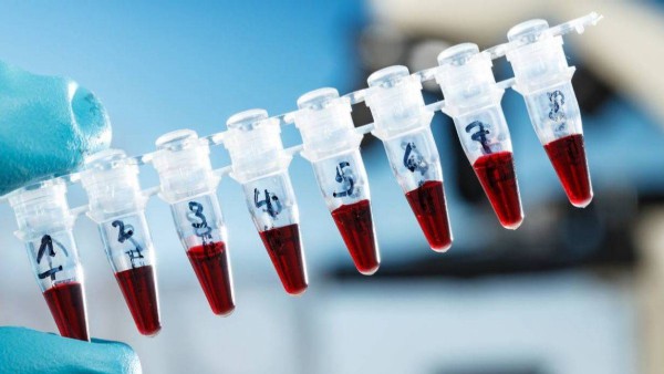 SMA Tarama Testi Nasıl Yapılır? Evlilik Öncesi SMA Taraması Nerede Yaptırılır?